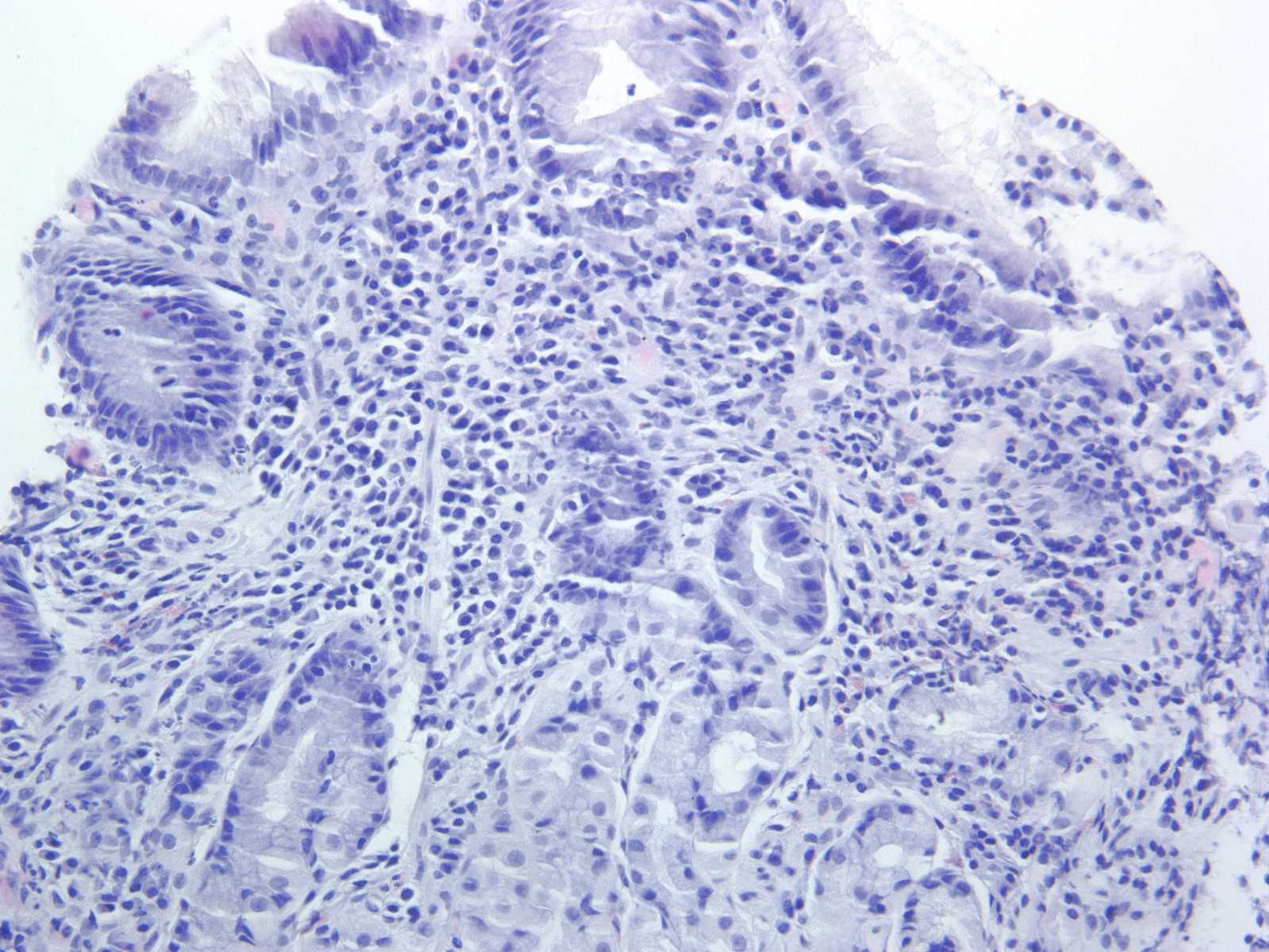 Mikroskopische Aufnahme einer Helicobacter-pylori-Gastritis der Magencorpusschleimhaut