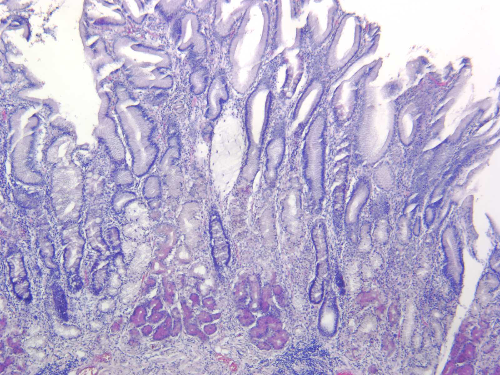 Mikroskopische Aufnahme einer atrophischen Autoimmungastritis der Magencorpusschleimhaut