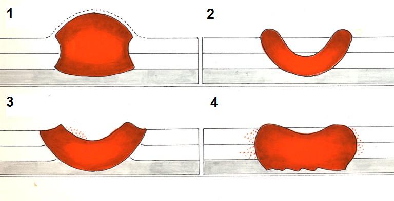 Schematische Darstellung der vier Tumortypen nach der Borrmann-Klassifikation