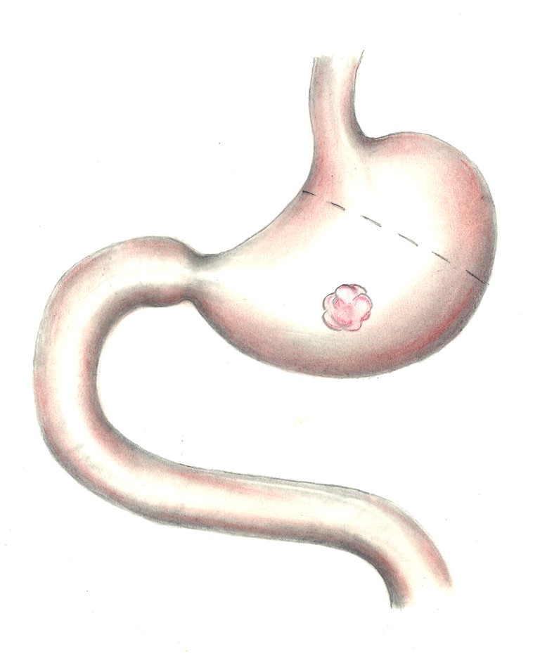 Abbildung 3: Die Abbildung zeigt einen klar lokalisierten Magentumor und die mögliche Resektionsgrenze für eine subtotale Magenresektion mit ausreichendem Abstand zum Tumor Lokalisierter Magentumor und mögliche Resektionsgrenze für eine subtotale Magenresektion