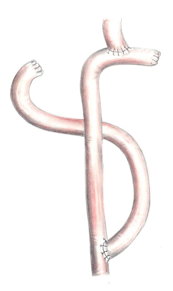 Schematische Darstellung des Zustands nach vollständiger Magenentfernung